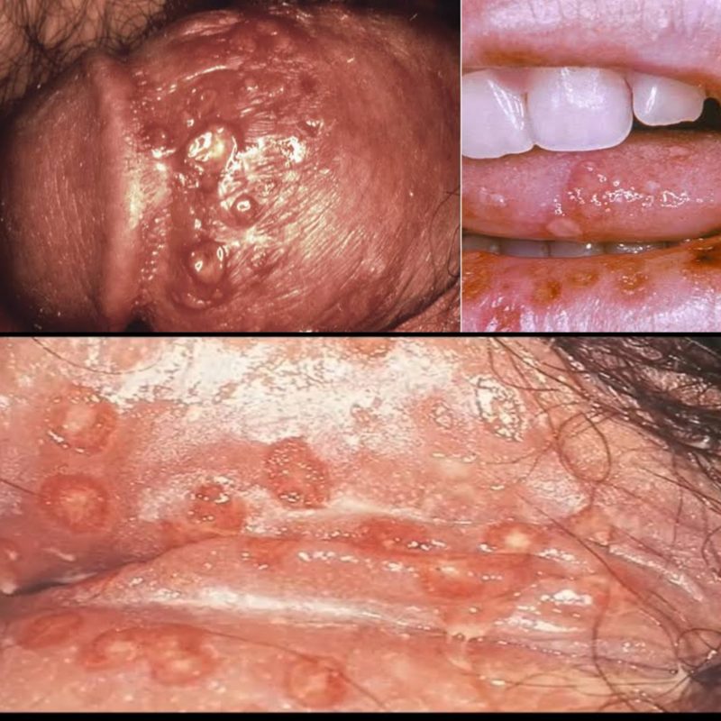 About Genital Herpes Fekomi Herbals