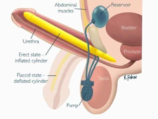 Penis Disorder - Fekomi Herbals