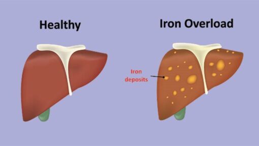 Hemochromatosis (iron overload) - Fekomi Herbals