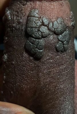 male genital warts